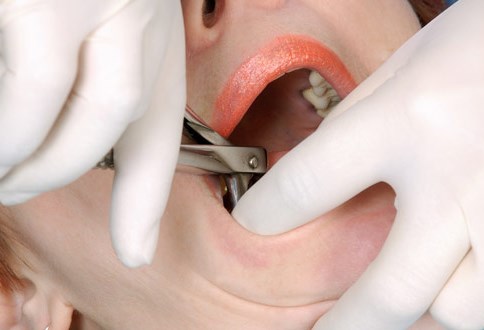 tooth-extraction-procedure.jpg