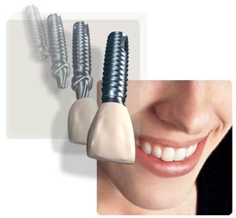 dental-implants1.jpg