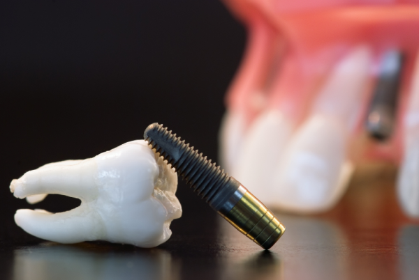dental-implants-procedure.png